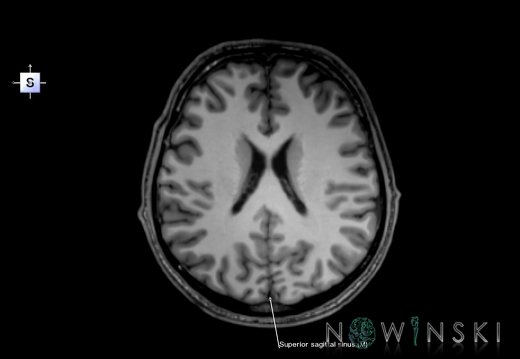 G6.T16.4.V5.P20.Dural sinuses–Triplanar