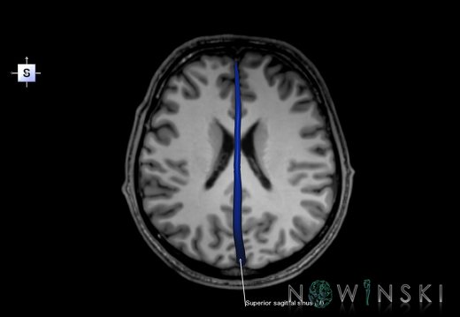 G6.T16.4.V5.P20S.Dural sinuses–Triplanar