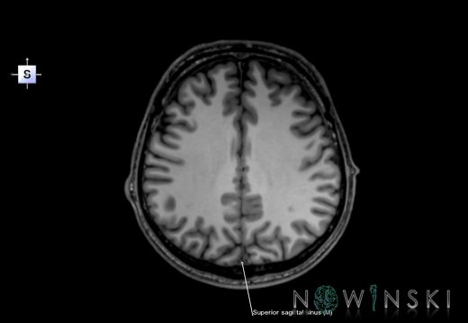 G6.T16.4.V5.P30.Dural sinuses–Triplanar