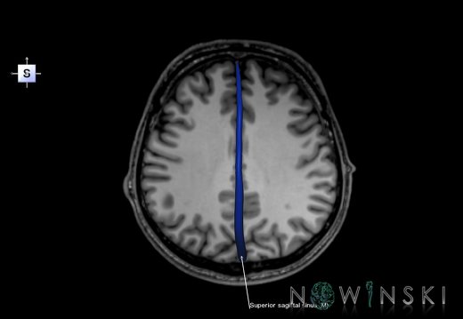 G6.T16.4.V5.P30S.Dural sinuses–Triplanar