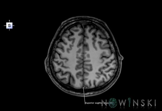 G6.T16.4.V5.P40.Dural sinuses–Triplanar