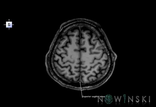 G6.T16.4.V5.P50.Dural sinuses–Triplanar