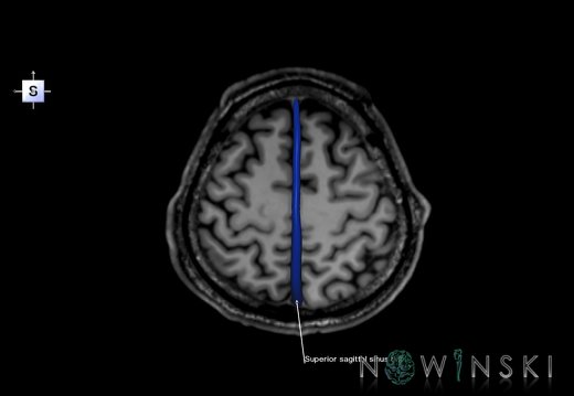 G6.T16.4.V5.P50S.Dural sinuses–Triplanar