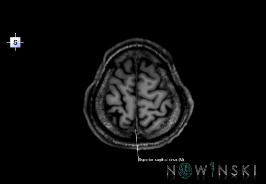 G6.T16.4.V5.P60.Dural sinuses–Triplanar