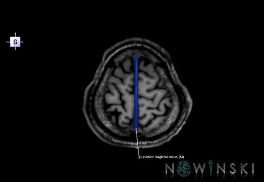 G6.T16.4.V5.P60S.Dural sinuses–Triplanar