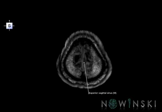 G6.T16.4.V5.P70.Dural sinuses–Triplanar