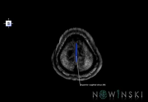 G6.T16.4.V5.P70S.Dural sinuses–Triplanar