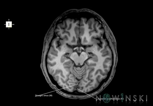 G6.T16.4.V6.P-10.Dural sinuses–Triplanar