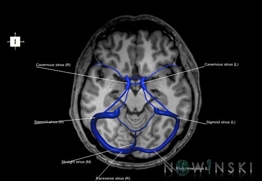 G6T16.4.DuralSinuses–Triplanar