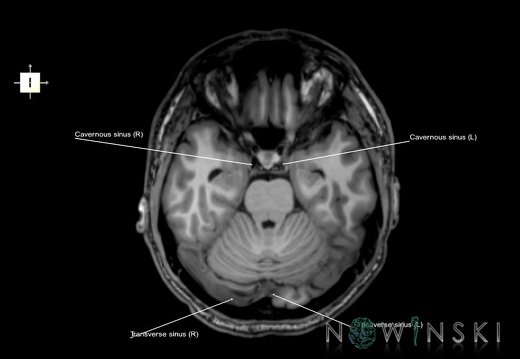 G6.T16.4.V6.P-20.Dural sinuses–Triplanar