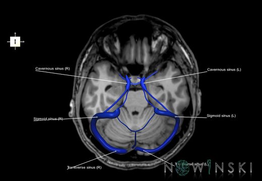 G6.T16.4.V6.P-20S.Dural sinuses–Triplanar