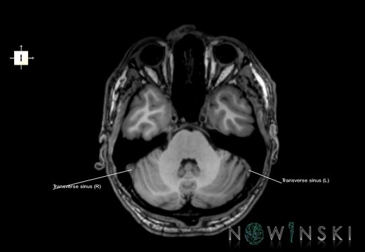 G6.T16.4.V6.P-30.Dural sinuses–Triplanar