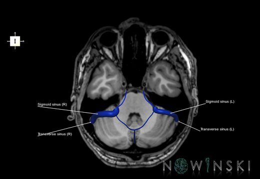 G6.T16.4.V6.P-30S.Dural sinuses–Triplanar