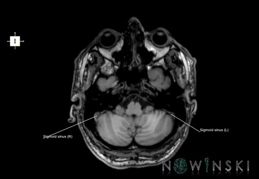 G6.T16.4.V6.P-40.Dural sinuses–Triplanar