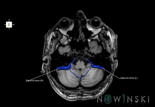 G6.T16.4.V6.P-40S.Dural sinuses–Triplanar