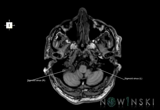 G6.T16.4.V6.P-50.Dural sinuses–Triplanar