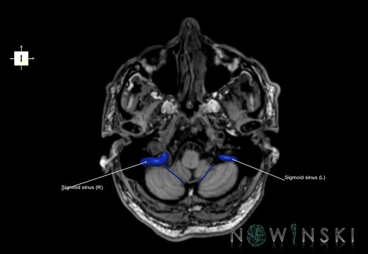 G6.T16.4.V6.P-50S.Dural sinuses–Triplanar