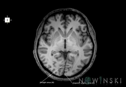 G6.T16.4.V6.P00.Dural sinuses–Triplanar