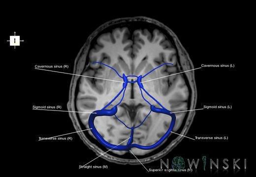 G6.T16.4.V6.P00S.Dural sinuses–Triplanar