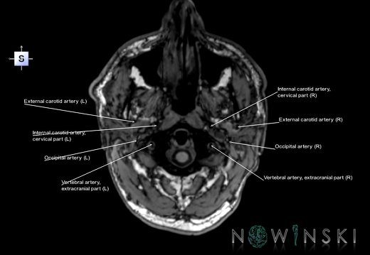 G6.T17.2.V5.P-70.Extracranial arteries–Triplanar