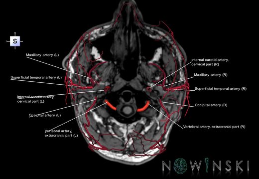 G6.T17.2.V5.P-70S.Extracranial arteries–Triplanar