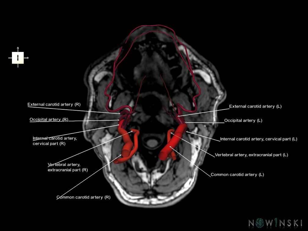 G6.T17.2.V6.P-90S.Extracranial arteries–Triplanar