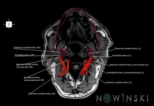 G6.T17.2.V6.P-90S.Extracranial arteries–Triplanar