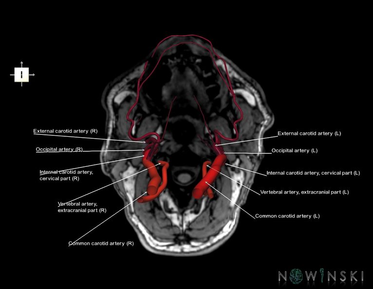 G6.T17.2.V6.P-90S.Extracranial_arteries–Triplanar.tiff