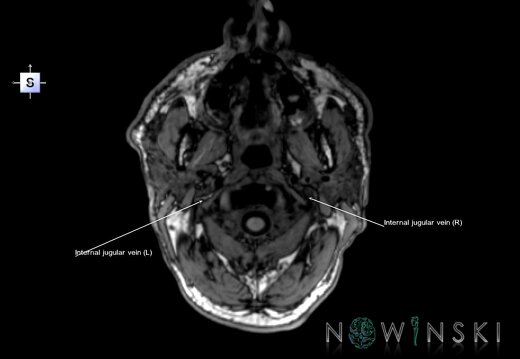 G6.T18.2.V5.P-80.Extracranial veins–Triplanar