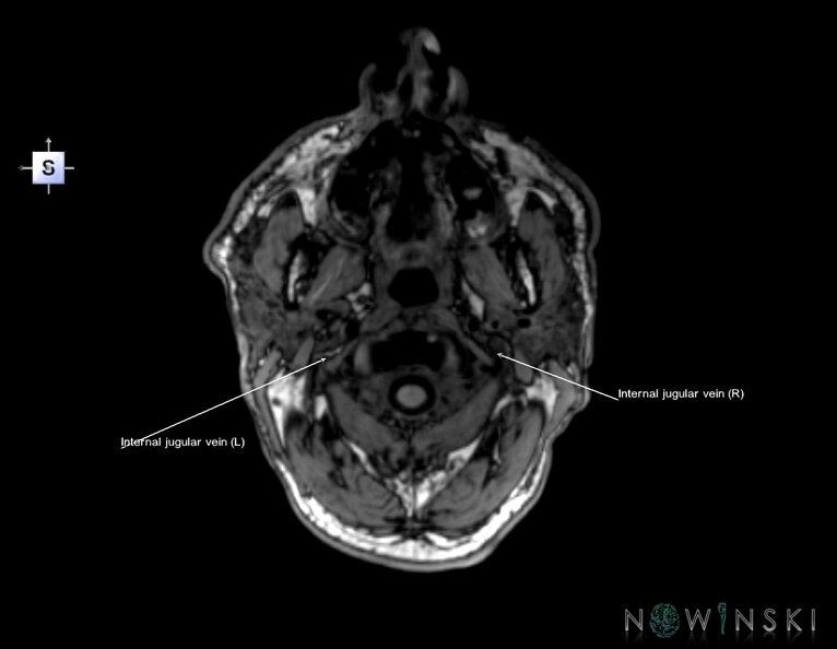 G6.T18.2.V5.P-80.Extracranial_veins–Triplanar.tiff