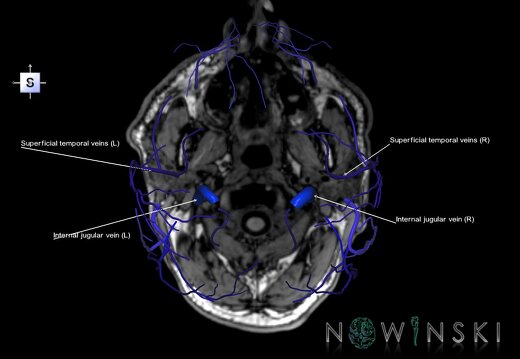 G6.T18.2.V5.P-80S.Extracranial veins–Triplanar