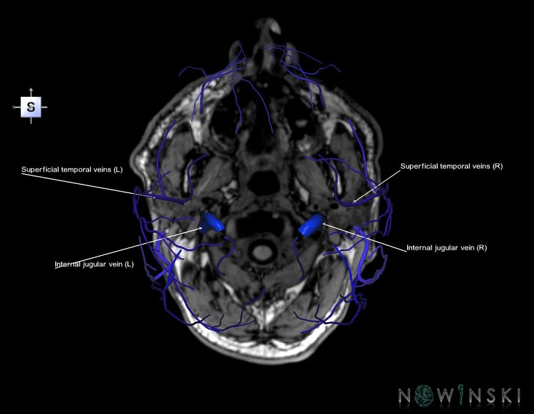 G6.T18.2.V5.P-80S.Extracranial_veins–Triplanar.tiff