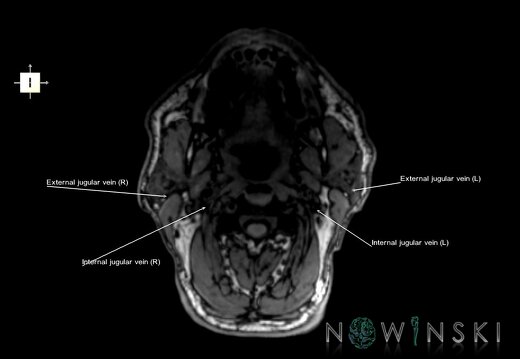 G6.T18.2.V6.P-100.Extracranial veins–Triplanar