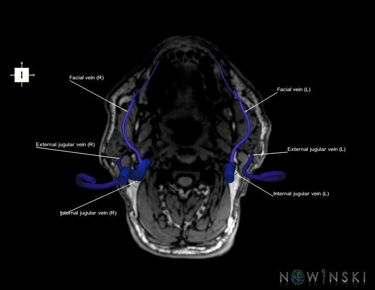 G6.T18.2.V6.P-100S.Extracranial_veins–Triplanar.tiff
