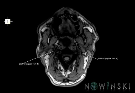 G6.T18.2.V6.P-90.Extracranial veins–Triplanar