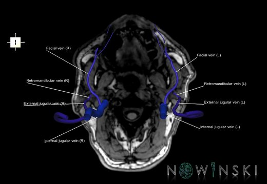 G6.T18.2.V6.P-90S.Extracranial veins–Triplanar