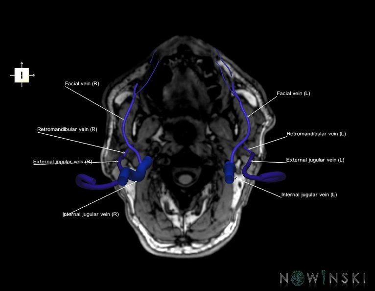 G6.T18.2.V6.P-90S.Extracranial_veins–Triplanar.tiff