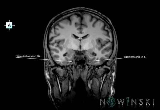 G6.T19.8.V1.P-09.Trigeminal nerve–Triplanar