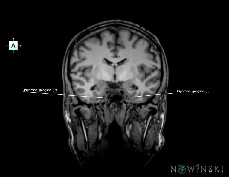 G6.T19.8.V1.P-09.Trigeminal_nerve–Triplanar.tiff