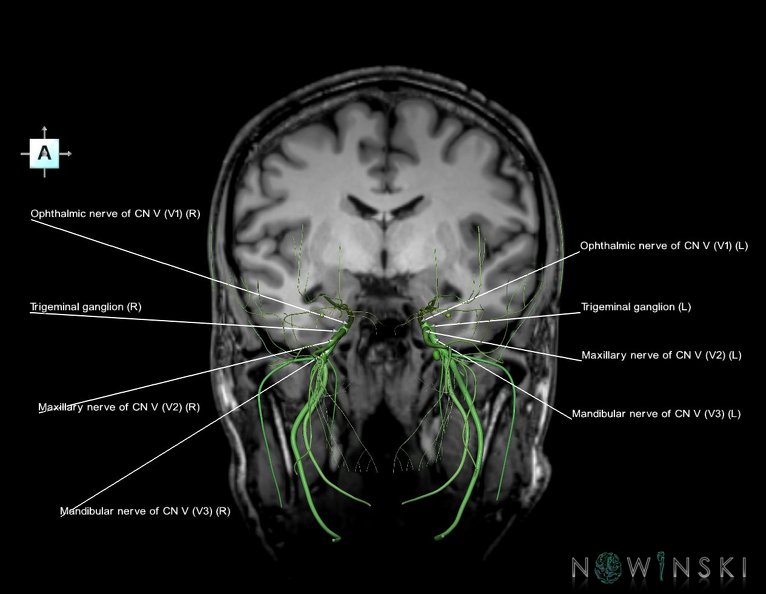 G6.T19.8.V1.P-09S.Trigeminal_nerve–Triplanar.tiff