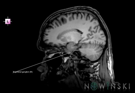 G6.T19.8.V2.P-18.Trigeminal nerve right–Triplanar