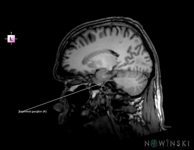 G6.T19.8.V2.P-18.Trigeminal_nerve_right–Triplanar.tiff