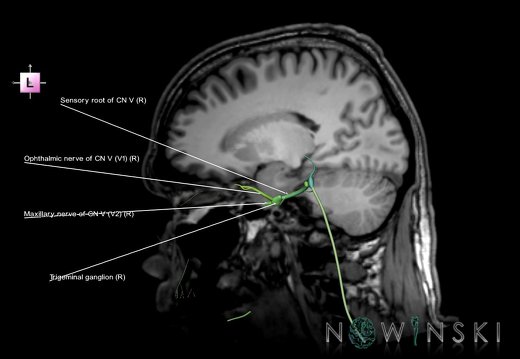 G6.T19.8.V2.P-18S.Trigeminal nerve right–Triplanar