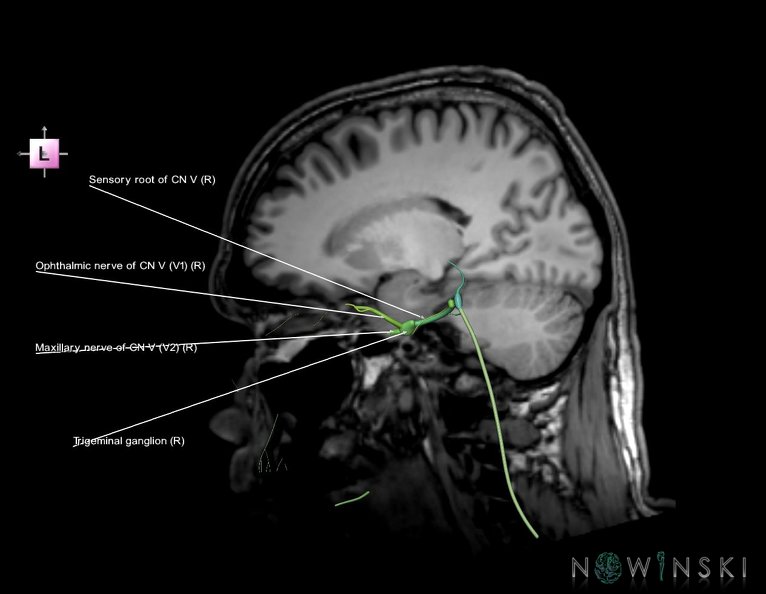 G6.T19.8.V2.P-18S.Trigeminal_nerve_right–Triplanar.tiff