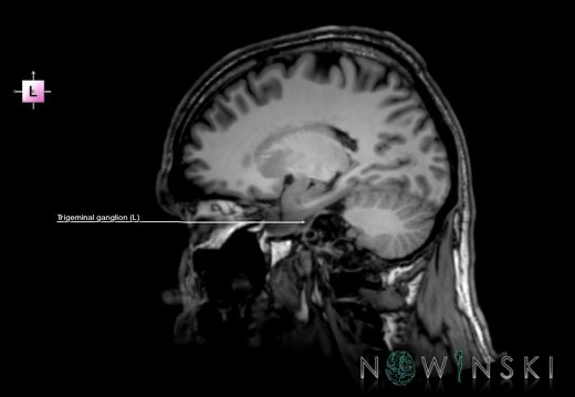 G6.T19.8.V2.P20.Trigeminal nerve–Triplanar