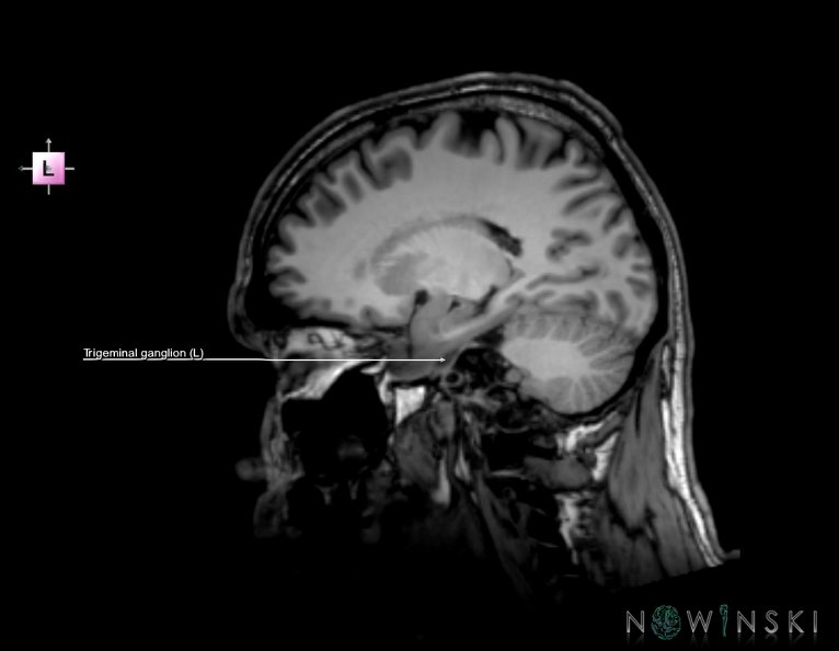 G6.T19.8.V2.P20.Trigeminal_nerve–Triplanar.tiff