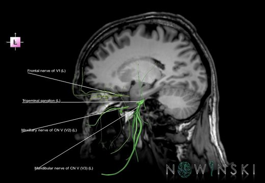 G6.T19.8.V2.P20S.Trigeminal nerve–Triplanar