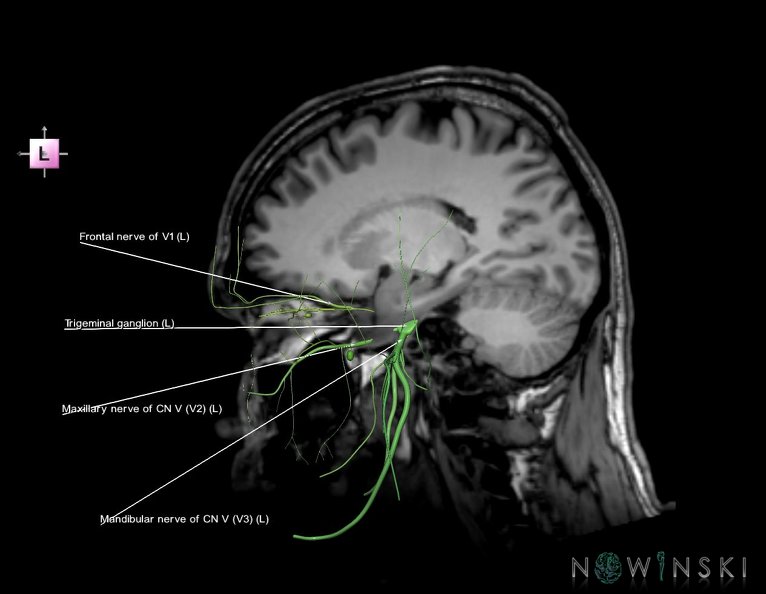 G6.T19.8.V2.P20S.Trigeminal_nerve–Triplanar.tiff
