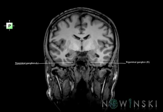 G6.T19.8.V3.P-09.Trigeminal nerve–Triplanar