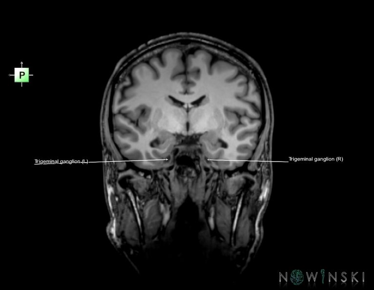 G6.T19.8.V3.P-09.Trigeminal_nerve–Triplanar.tiff